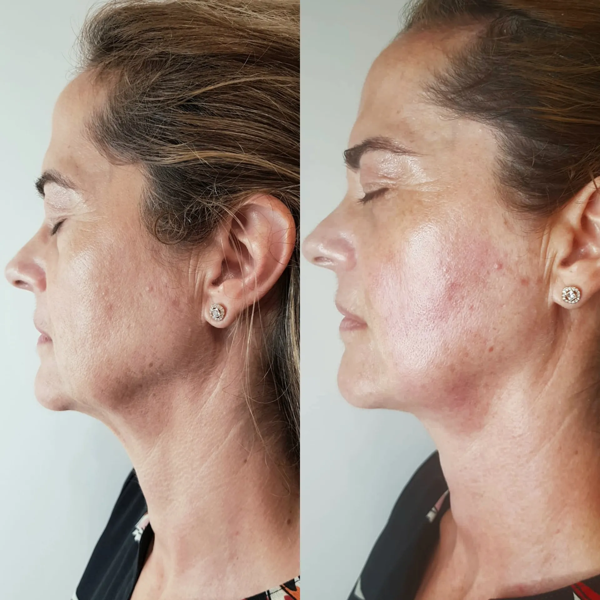 HIFU — Antes / Depois
