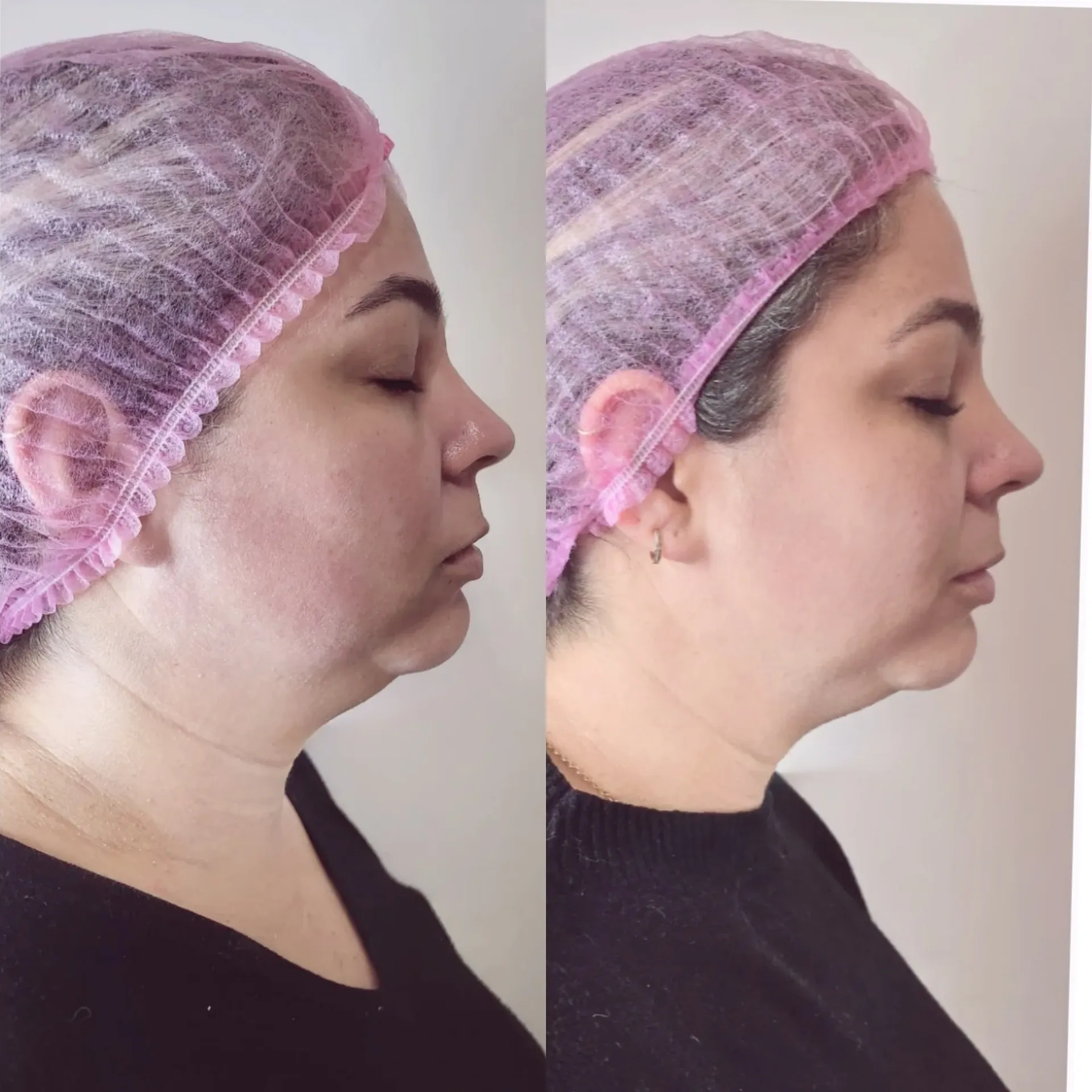 HIFU — Antes / Depois