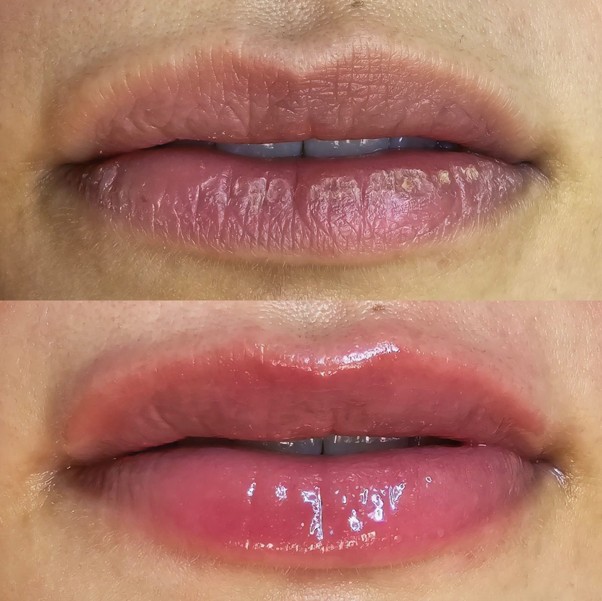 Hydra Gloss — Antes / Depois