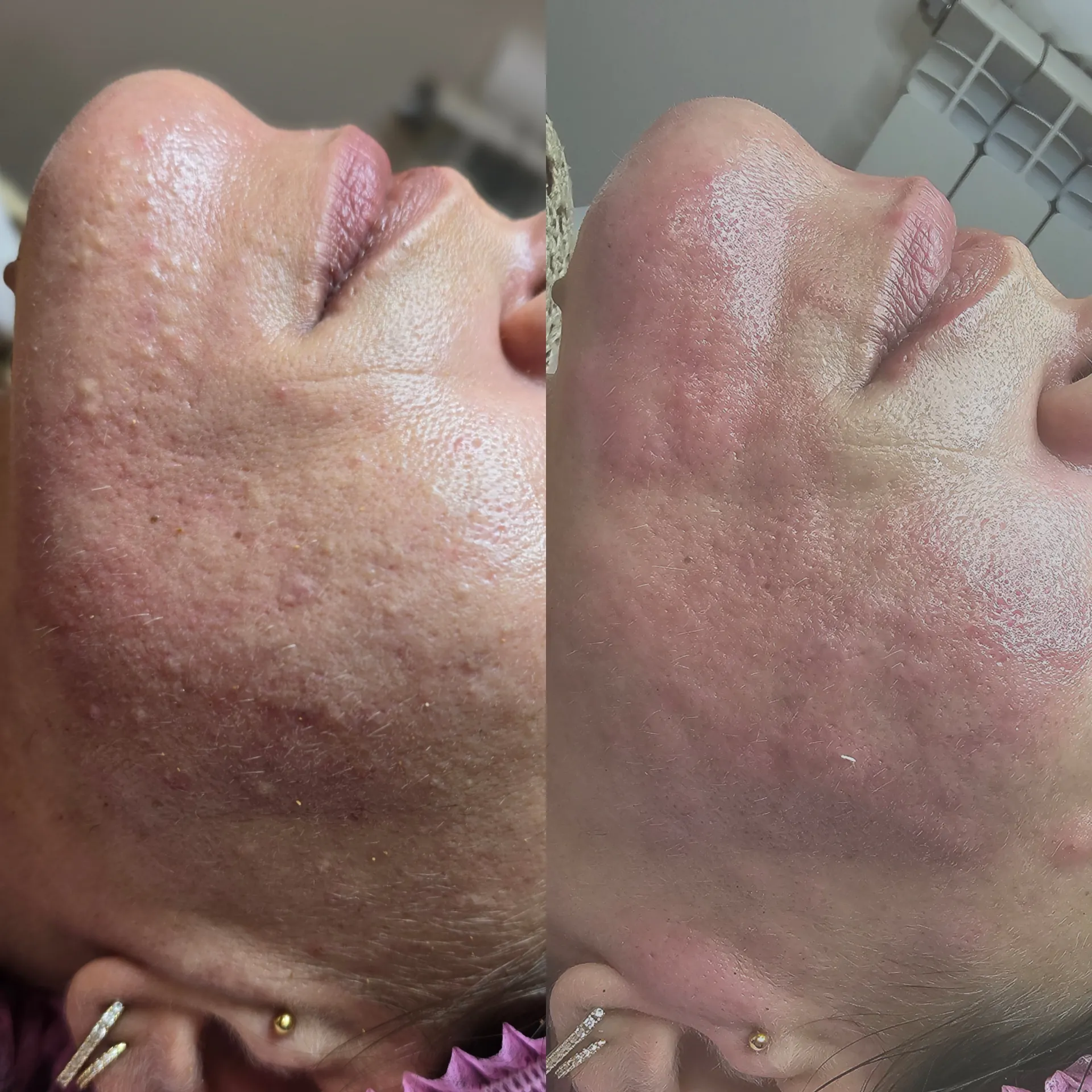 Limpeza de Pele — Antes / Depois