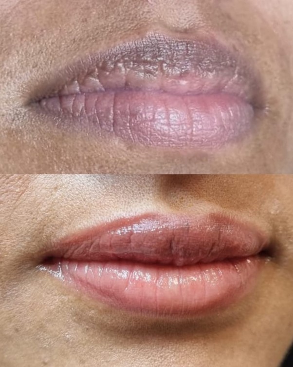 Micropigmentação Labial — Antes / Depois