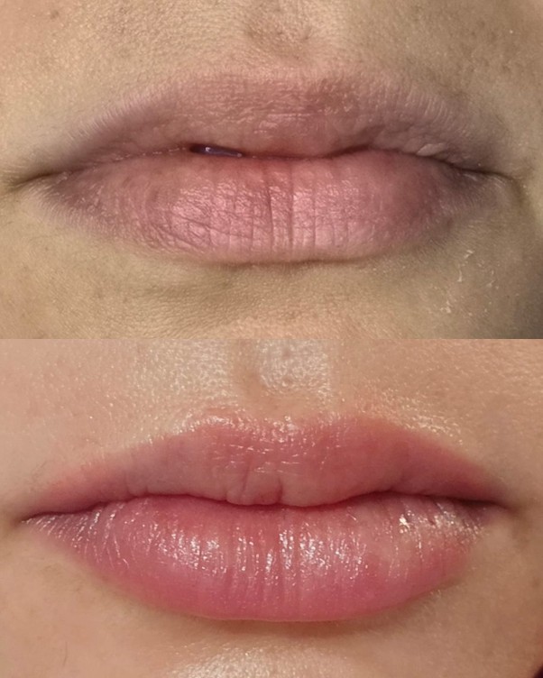 Micropigmentação Labial — Antes / Depois