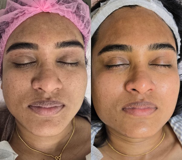 Peeling Rose de Mer — Antes / Depois