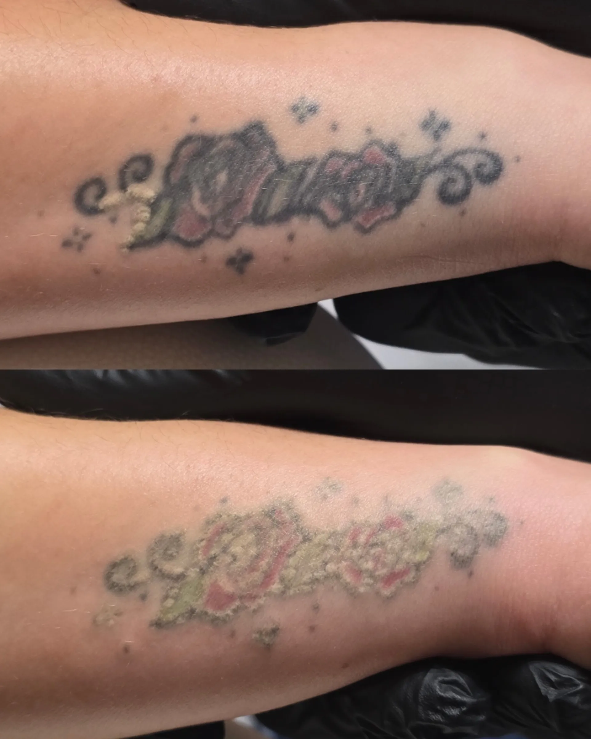 Remoção de Tatuagem — resultado após a 2.ª sessão