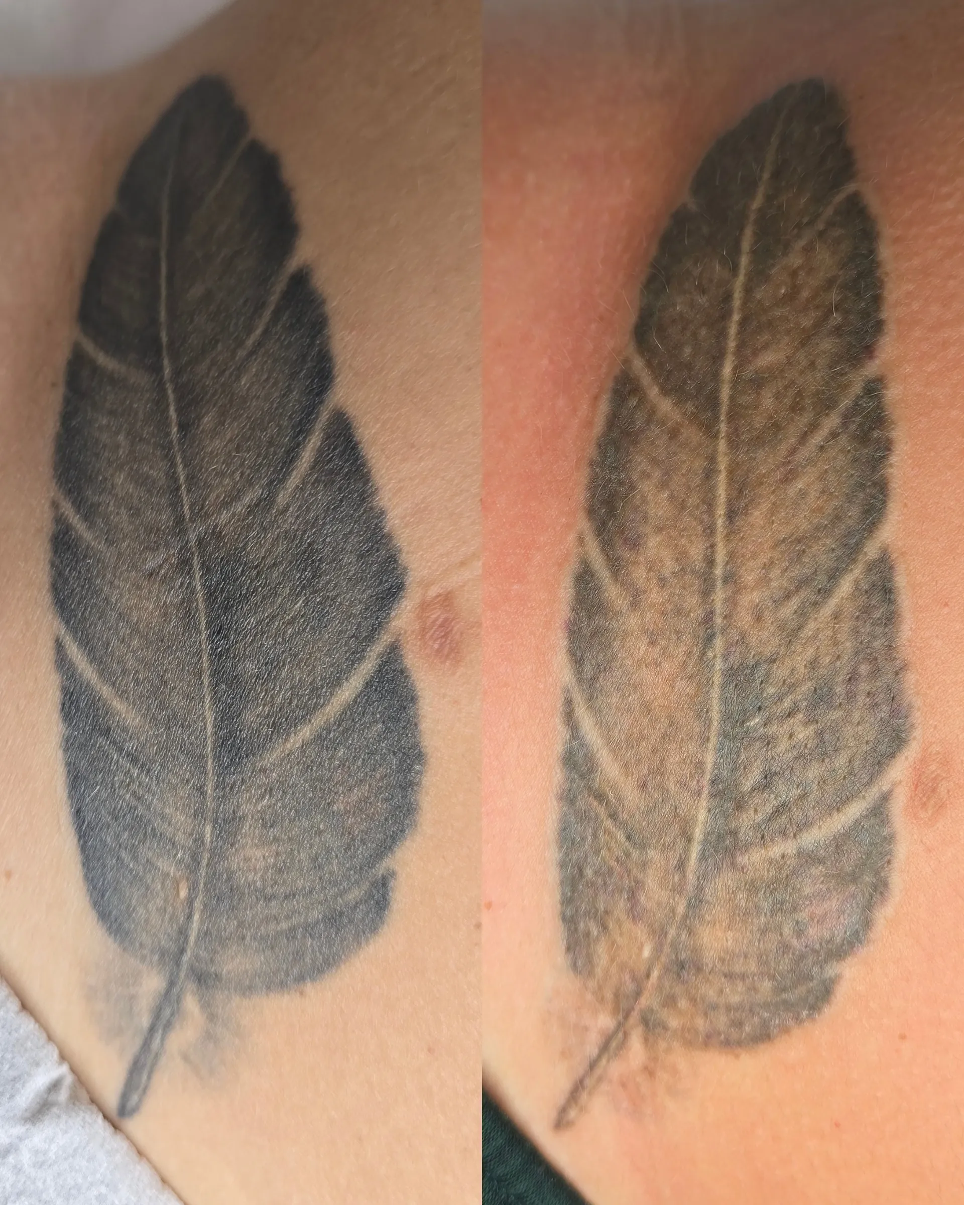 Remoção de Tatuagem — resultado após a 2.ª sessão